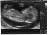 Echographie 1 - Octobre 2007