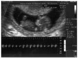 Echographie 1 - Octobre 2007