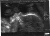 Echographie 2 - Décembre 2007