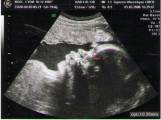 Echographie 3 - Mars 2008