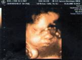 Echographie 3 - Mars 2008